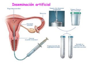 Inseminación artificial
 