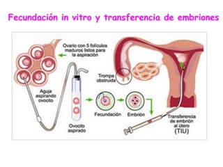 Fecundación in vitro y transferencia de embriones
 