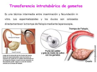 Transferencia intratubárica de gametos
 
