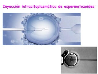 Inyección intracitoplasmática de espermatozoides
 