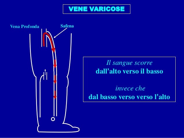 Laser per coagulazione endovenous