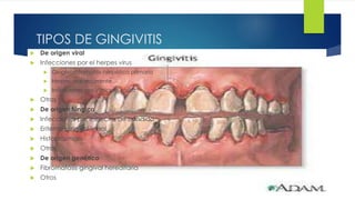 TIPOS DE GINGIVITIS 
 De origen viral 
 Infecciones por el herpes virus 
 Gingivoestomatitis herpética primaria 
 Herpes oral recurrente 
 Infecciones por Varicella zóster 
 Otras 
 De origen fúngico 
 Infecciones por especies de cándida 
 Eritema gingival lineal 
 Histoplasmosis 
 Otras 
 De origen genético 
 Fibromatosis gingival hereditaria 
 Otros 
 