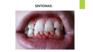 SINTOMAS: 
 