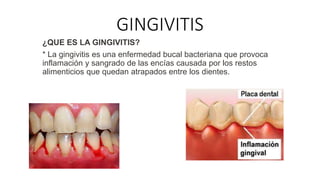 GINGIVITIS
¿QUE ES LA GINGIVITIS?
* La gingivitis es una enfermedad bucal bacteriana que provoca
inflamación y sangrado de las encías causada por los restos
alimenticios que quedan atrapados entre los dientes.
 