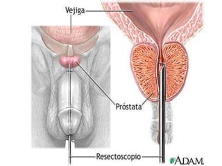 La glándula prostática 2