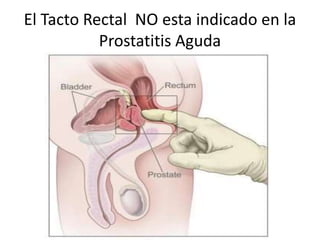 El Tacto Rectal NO esta indicado en la
Prostatitis Aguda
 