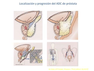 Localización y progresión del ADC de próstata
An Atlas of Prostatic Diseases. Third edition. Pp 63-67
 