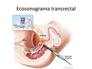Ecosonograma transrectal
 