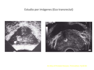 Estudio por imágenes (Eco transrectal)
An Atlas of Prostatic Diseases. Third edition. Pp 82-83
 