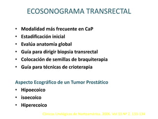 ECOSONOGRAMA TRANSRECTAL
• Modalidad más frecuente en CaP
• Estadificación inicial
• Evalúa anatomía global
• Guía para dirigir biopsia transrectal
• Colocación de semillas de braquiterapia
• Guía para técnicas de crioterapia
Aspecto Ecográfico de un Tumor Prostático
• Hipoecoico
• isoecoico
• Hiperecoico
Clínicas Urológicas de Norteamérica. 2006. Vol 33 Nº 2. 133-134
 