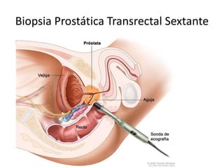 Biopsia Prostática Transrectal Sextante
 