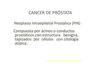 CANCER DE PRÓSTATA
Neoplasia Intraepitelial Prostática (PIN)
Compuesta por ácinos o conductos
prostáticos con estructura benigna,
tapizados por células con citología
atípica.
Campbell. 2005. 8ª edición. Tomo 4. pp. 3313
 