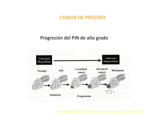 CANCER DE PRÓSTATA
Progresión del PIN de alto grado
Jack H Mydlo. 2003. Prostate Cancer.Science and clinical practice. Pp 35
 