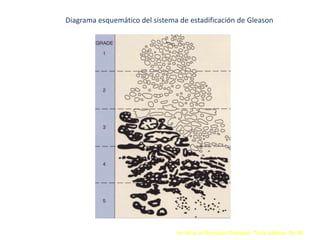 Diagrama esquemático del sistema de estadificación de Gleason
An Atlas of Prostatic Diseases. Third edition. Pp 48
 