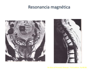 Resonancia magnética
An Atlas of Prostatic Diseases. Third edition. Pp 88-89
 