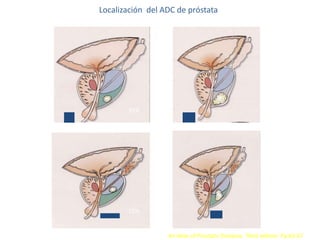 Localización del ADC de próstata
An Atlas of Prostatic Diseases. Third edition. Pp 63-67
85%
15%
 
