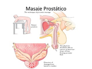 Masaje Prostático
 