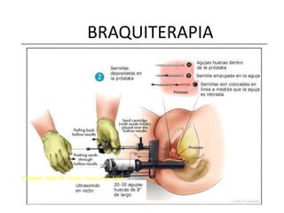 BRAQUITERAPIA
Campbell. 2005. 8ª edición. Tomo 4. pp. 3456
 