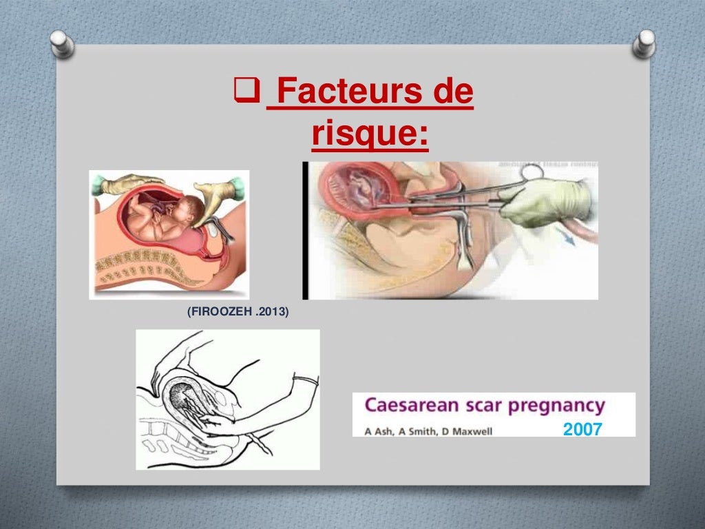 La grossesse sur cicatrice de césarienne (1) (1)