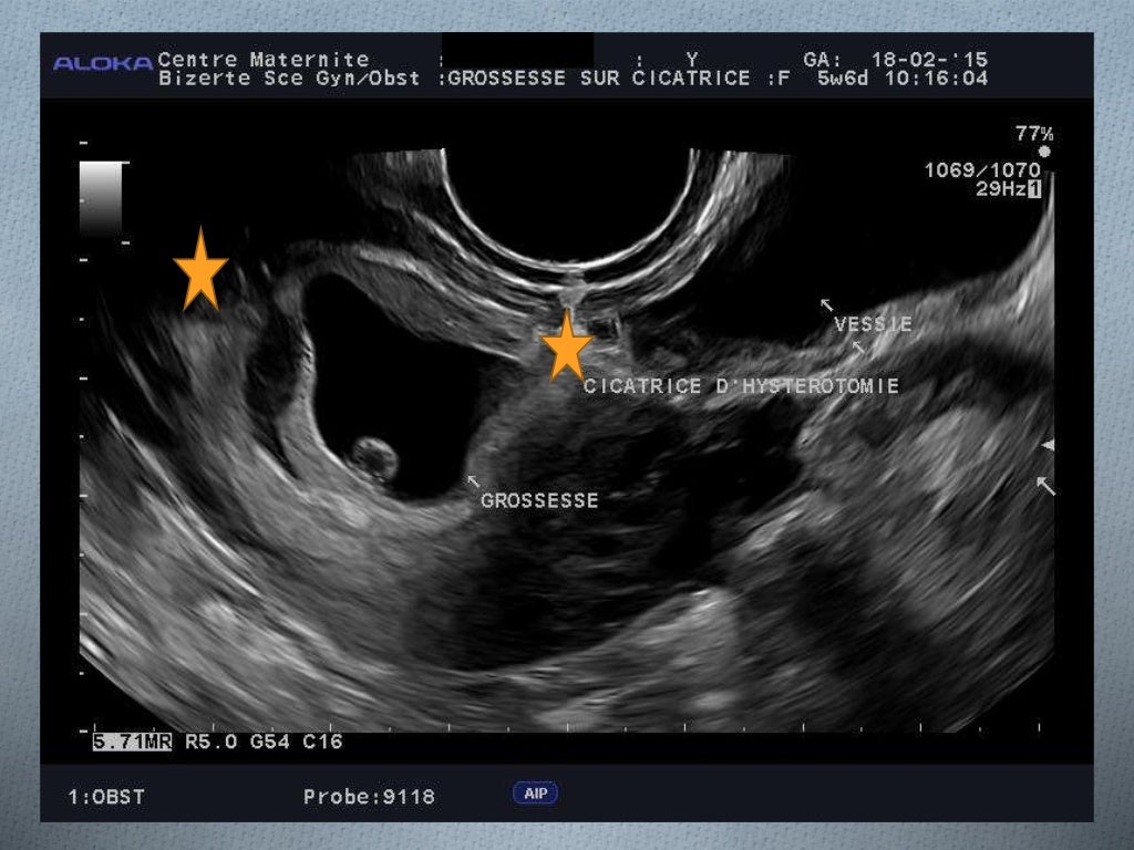 La grossesse sur cicatrice de césarienne (1) (1)