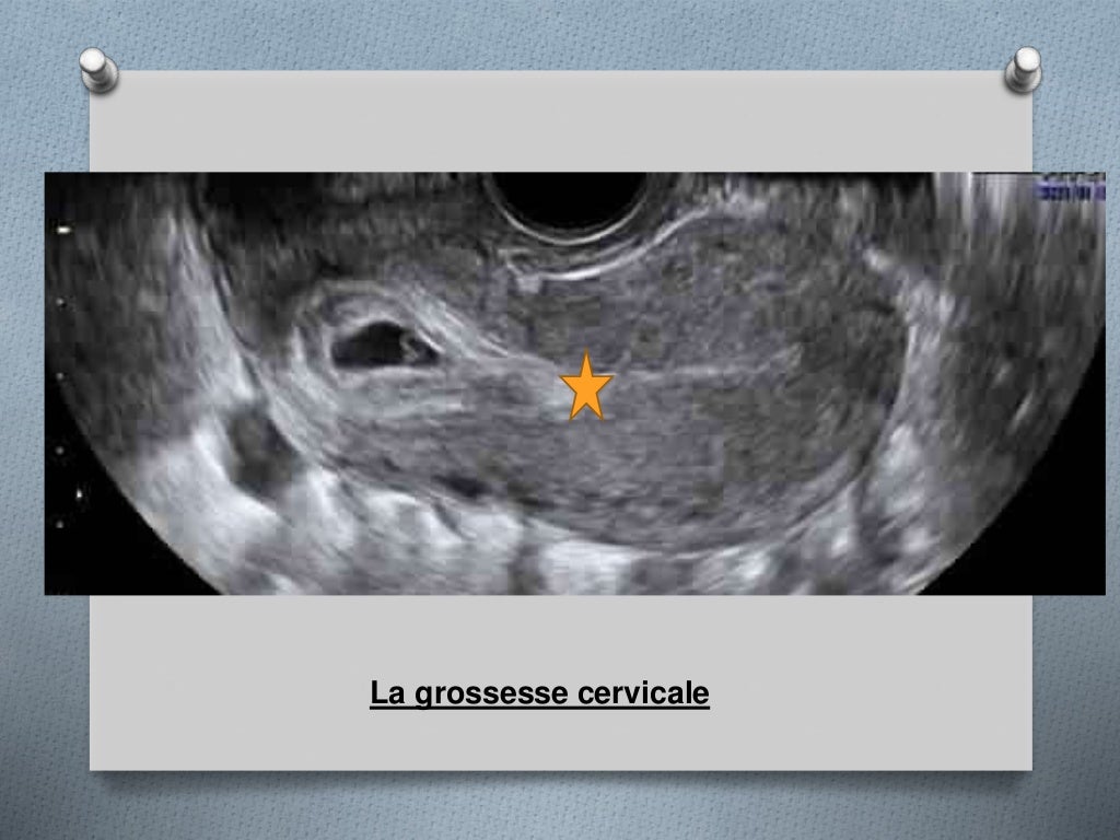 La grossesse sur cicatrice de césarienne (1) (1)