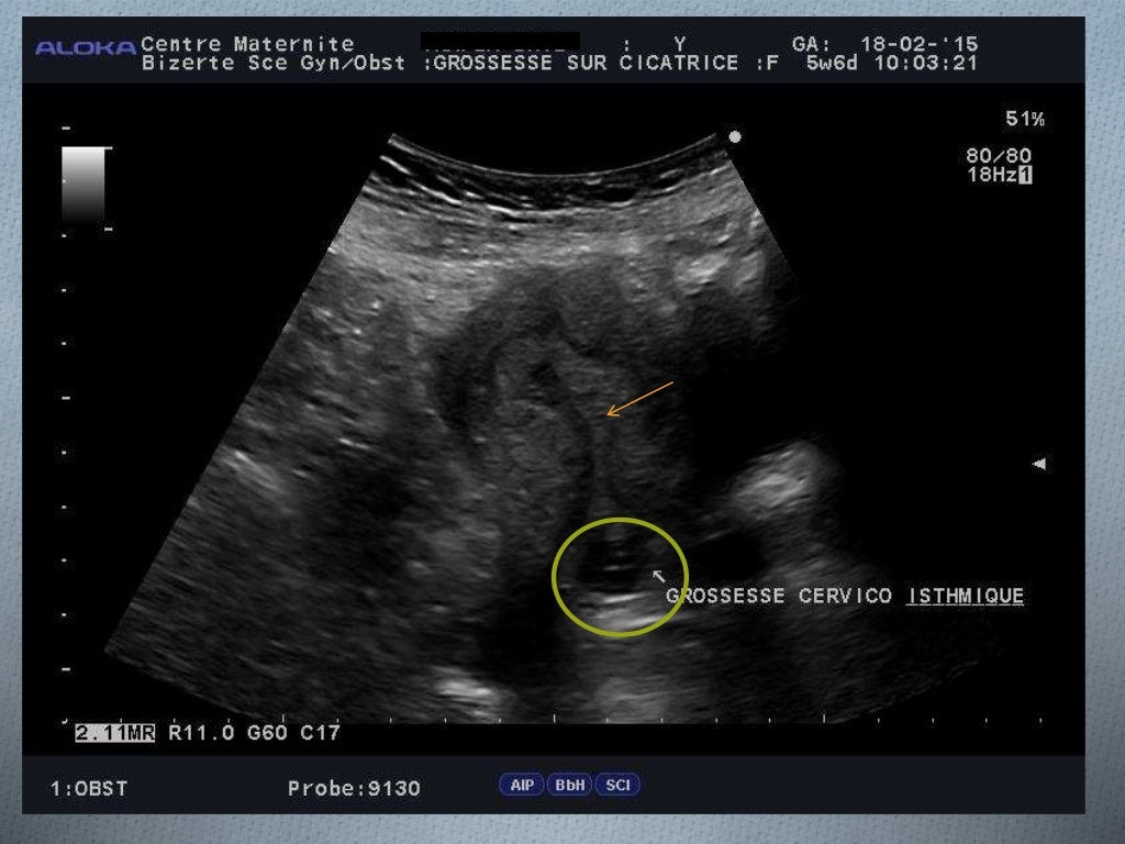 La grossesse sur cicatrice de césarienne (1) (1)