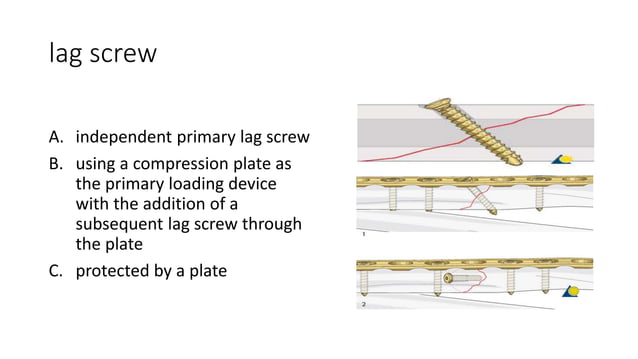 LAG SCREW PRINCIPLES.ppt