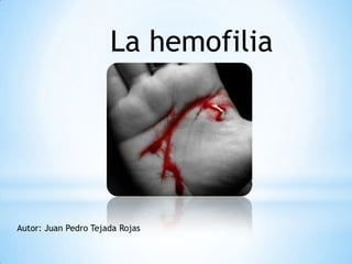 La hemofilia
Autor: Juan Pedro Tejada Rojas
 