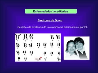 Enfermedades   hereditarias   Síndrome de Down Se debe a la existencia de un cromosoma adicional en el par 21.  