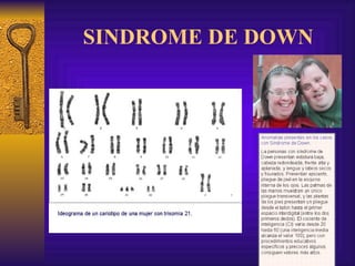 SINDROME DE DOWN 