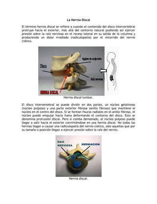 La Hernia Discal

El término hernia discal se refiere a cuando el contenido del disco intervertebral
protruye hacia el exterior, más allá del contorno natural pudiendo así ejercer
presión sobre la raíz nerviosa en el receso lateral en su salida de la columna y
produciendo un dolor irradiado (radiculopatía) por el recorrido del nervio
ciático.




                               Hernia discal lumbar.

El disco intervertebral se puede dividir en dos partes, un núcleo gelatinoso
(núcleo pulposo) y una parte exterior fibrosa (anillo fibroso) que mantiene el
núcleo en el centro del disco. Si se forman fisuras radiales en el anillo fibroso, el
núcleo puede empujar hacia fuera deformando el contorno del disco. Esto se
denomina protrusión discal. Pero si comba demasiado, el núcleo pulposo puede
llegar a salir hacia el exterior convirtiéndose en una hernia discal. No todas las
hernias llegan a causar una radiculopatía del nervio ciático, sólo aquellas que por
su tamaño o posición llegan a ejercer presión sobre la raíz del nervio.




                                   Hernia discal.
 