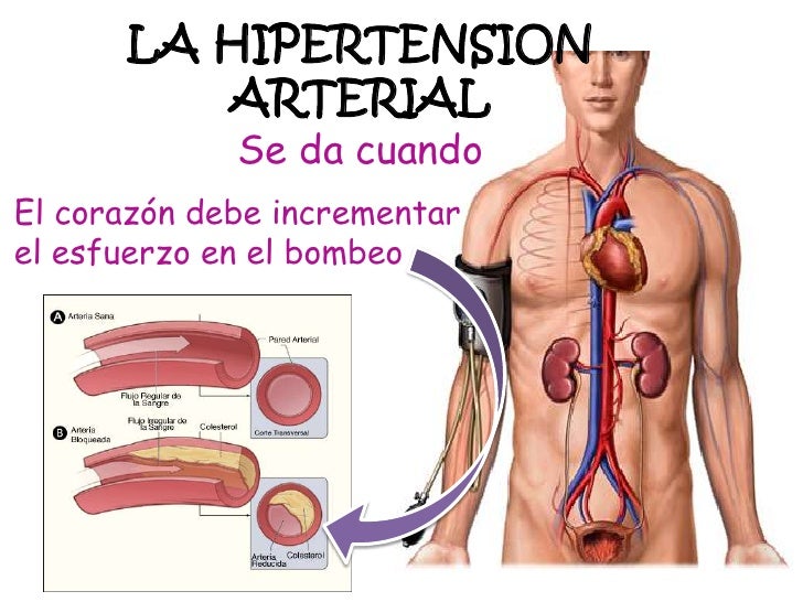 La hipertension arterial