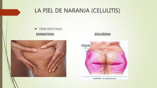 LA PIEL DE NARANJA (CELULITIS)
 TIENE DOS FASES:
EDEMATOSA ESCLEROSA
 