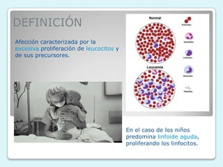 DEFINICIÓN
Afección caracterizada por la
excesiva proliferación de leucocitos y
de sus precursores.
En el caso de los niño...