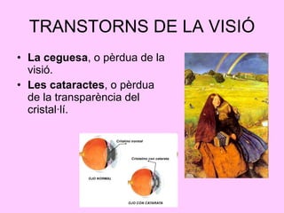 TRANSTORNS DE LA VISIÓ <ul><li>La ceguesa , o pèrdua de la visió. </li></ul><ul><li>Les cataractes , o pèrdua de la transp...
