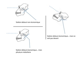 Sta(on	
  debout	
  non	
  économique	
  
Sta(on	
  debout	
  économique…	
  mais	
  
plicature	
  médullaire	
  
Sta(on	
  debout	
  économique…	
  mais	
  ne	
  
voit	
  pas	
  devant	
  
 
