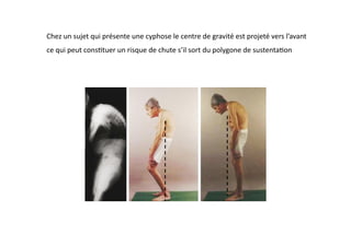 Chez	
  un	
  sujet	
  qui	
  présente	
  une	
  cyphose	
  le	
  centre	
  de	
  gravité	
  est	
  projeté	
  vers	
  l’avant	
  
ce	
  qui	
  peut	
  cons(tuer	
  un	
  risque	
  de	
  chute	
  s’il	
  sort	
  du	
  polygone	
  de	
  sustenta(on	
  
 