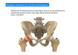 Quelques	
  exemples	
  de	
  marche	
  pathologique	
  
Boiterie	
  par	
  enraidissement	
  d’une	
  ar(cula(on,	
  dans	
  le	
  cas	
  par	
  exemple	
  d’une	
  
coxarthrose	
  qui	
  peut	
  survenir	
  avec	
  l’âge,	
  aﬀecte	
  la	
  phase	
  oscillante	
  
Cause	
  :	
  ar(culaire	
  
 
