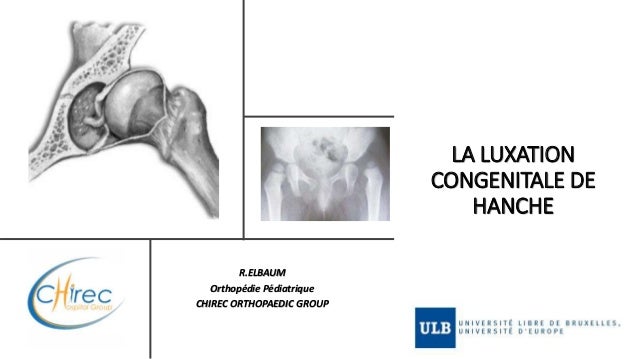 La Luxation Congenitale De La Hanche
