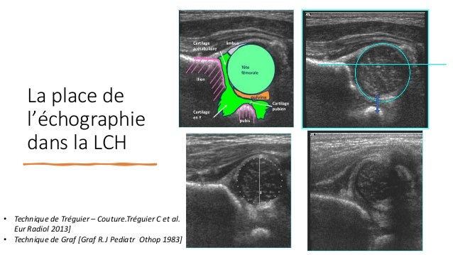 La Luxation Congenitale De La Hanche