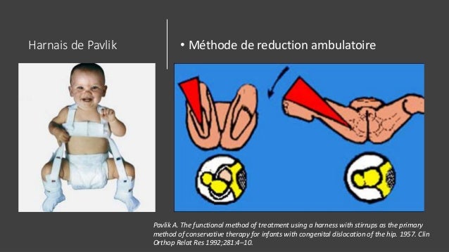 La Luxation Congenitale De La Hanche
