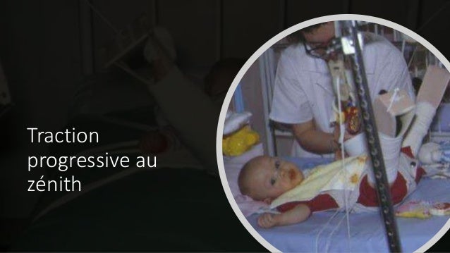La Luxation Congenitale De La Hanche