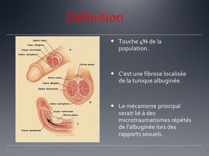Maladie de lapeyronie et viagra