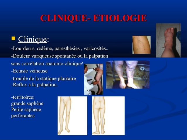 Quels symptômes de la varicosité sur les pieds