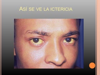 ASÍ SE VE LA ICTERICIA
 