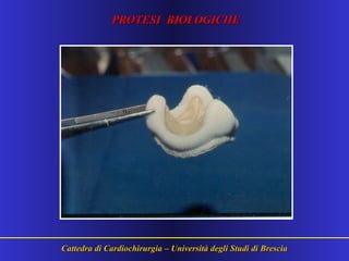 Cattedra di Cardiochirurgia – Università degli Studi di BresciaCattedra di Cardiochirurgia – Università degli Studi di Brescia
PROTESI BIOLOGICHEPROTESI BIOLOGICHE
 