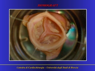 Cattedra di Cardiochirurgia – Università degli Studi di BresciaCattedra di Cardiochirurgia – Università degli Studi di Brescia
HOMOGRAFTHOMOGRAFT
 