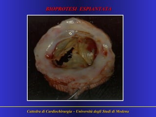 Cattedra di Cardiochirurgia – Università degli Studi di ModenaCattedra di Cardiochirurgia – Università degli Studi di Modena
BIOPROTESI ESPIANTATABIOPROTESI ESPIANTATA
 
