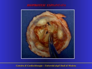 Cattedra di Cardiochirurgia – Università degli Studi di ModenaCattedra di Cardiochirurgia – Università degli Studi di Modena
BIOPROTESI ESPIANTATABIOPROTESI ESPIANTATA
 