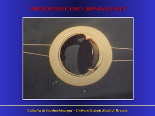 Cattedra di Cardiochirurgia – Università degli Studi di BresciaCattedra di Cardiochirurgia – Università degli Studi di Brescia
PROTESI MECCANICA MONO-LEAFLETPROTESI MECCANICA MONO-LEAFLET
 